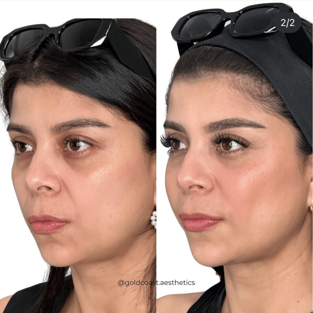 Full face transformation result