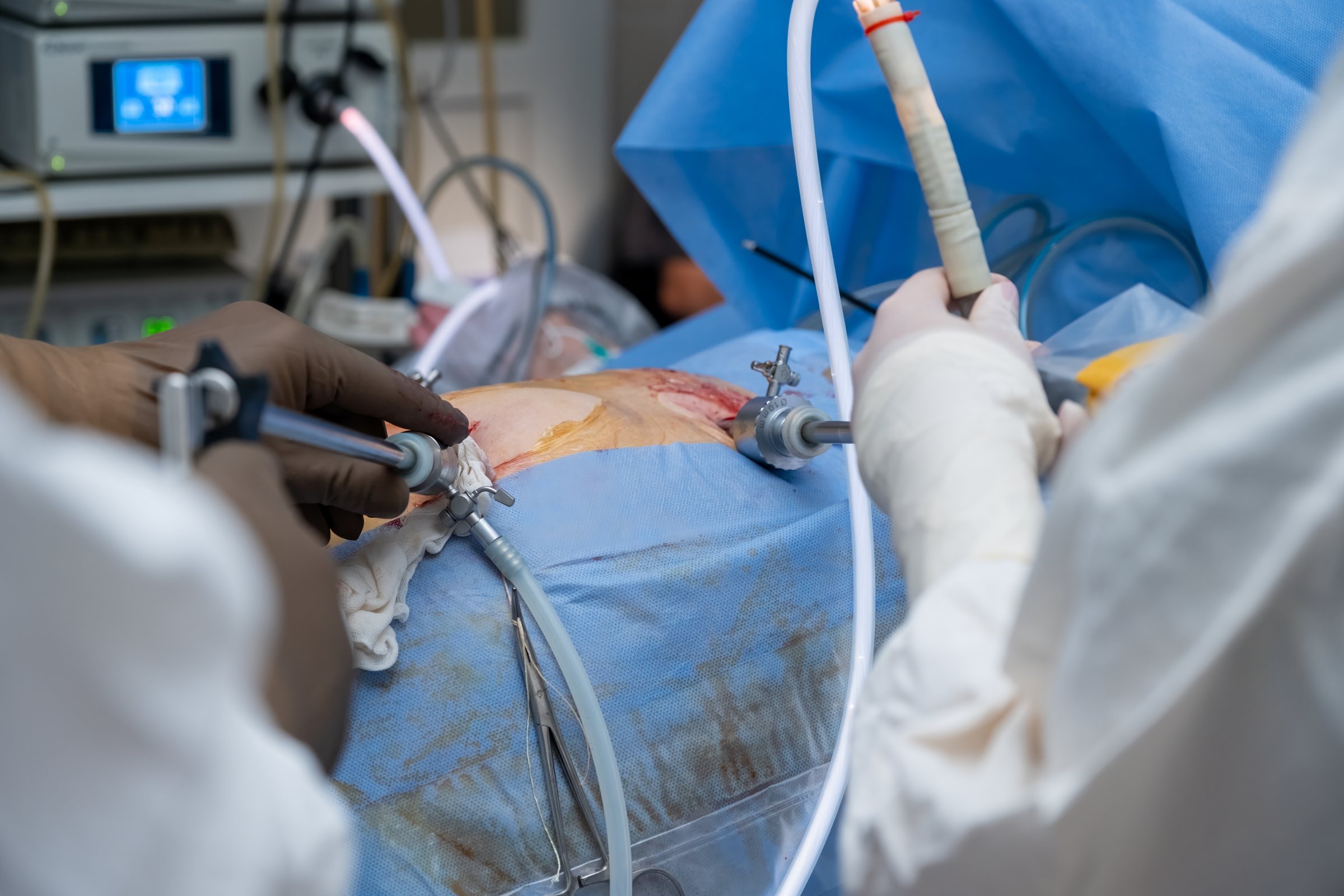 Surgeons performing a minimally invasive laparoscopic surgery on a patient in a sterile hospital operating room using specialized surgical instruments and advanced medical technology