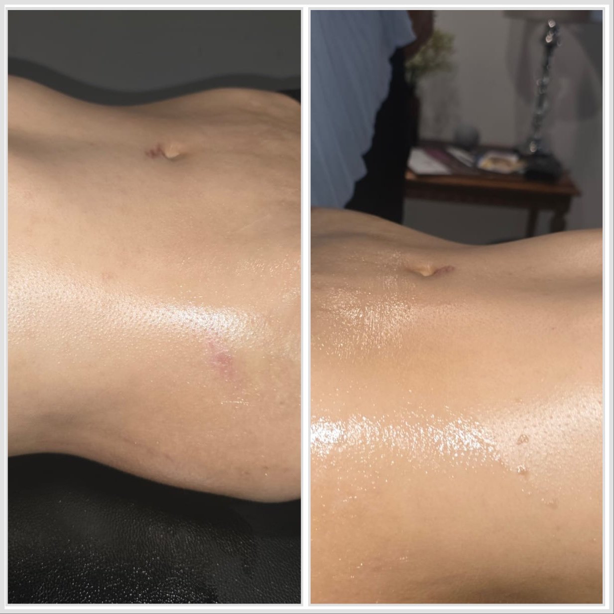 Antes y después - Eliminación de estrías