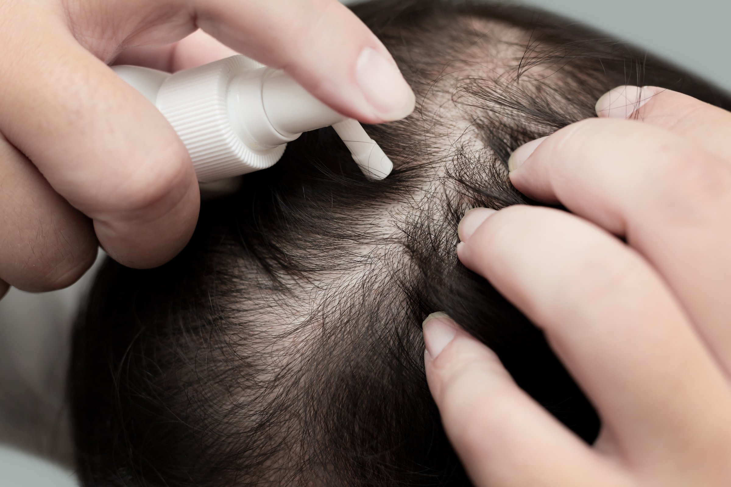 Close up of male's hand using medication on scalp, treating for Alopecia, hair loss, dandruff or hair problem