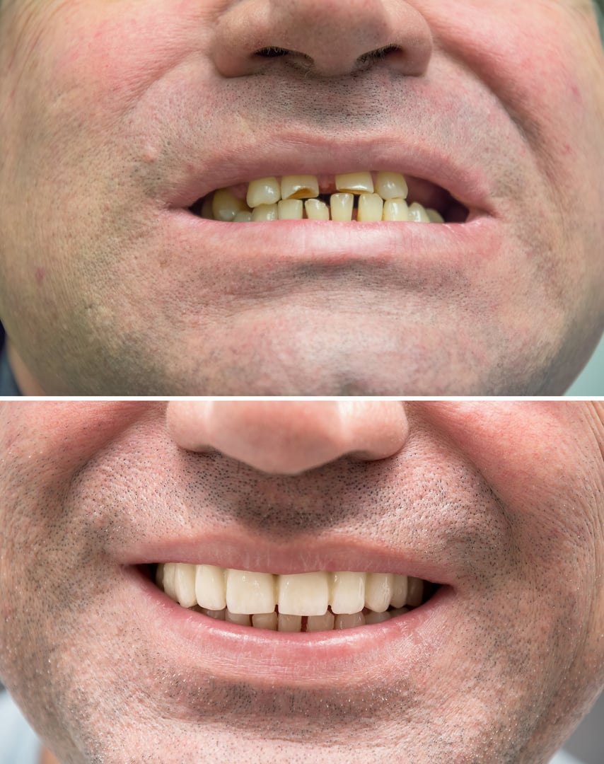 Real photographs of the mouth of a male patient Before and After prosthetics of the upper teeth with removable telescopic dentures. Comparative collage. Dentistry and prosthetics concept.