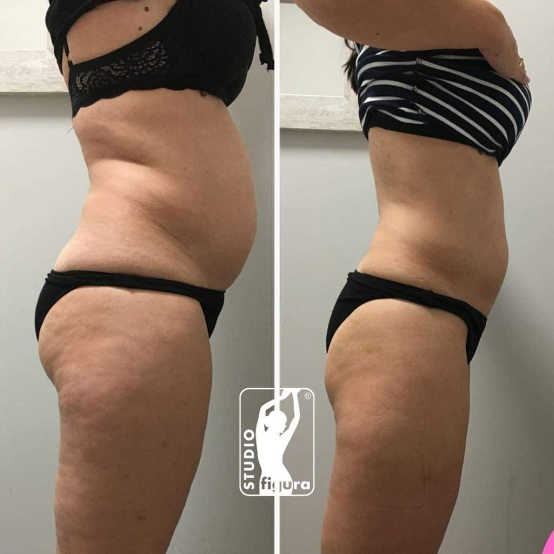 Efekt endermologii - przed i po