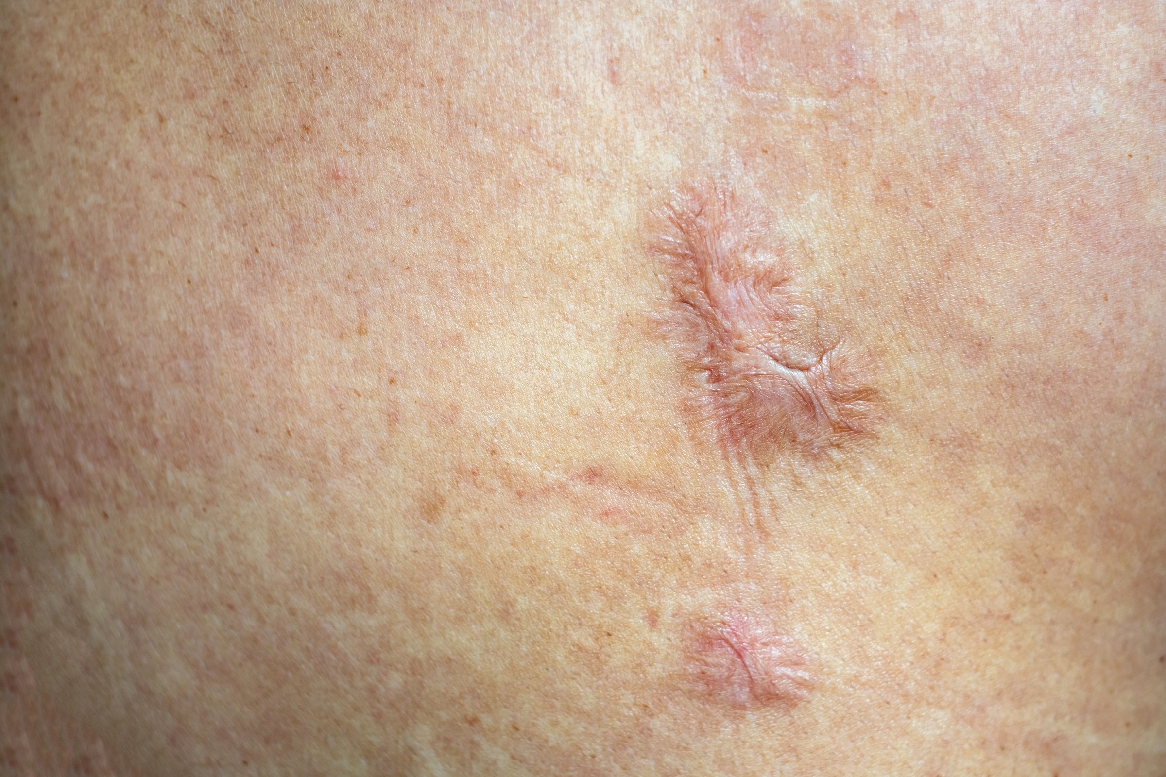 Close up of keloid scar caused by surgery or scars from wounds, skin imperfections or defects. Scar texture on body skin after surgical and treatmaent, dermatology and cosmetology concept, healt care