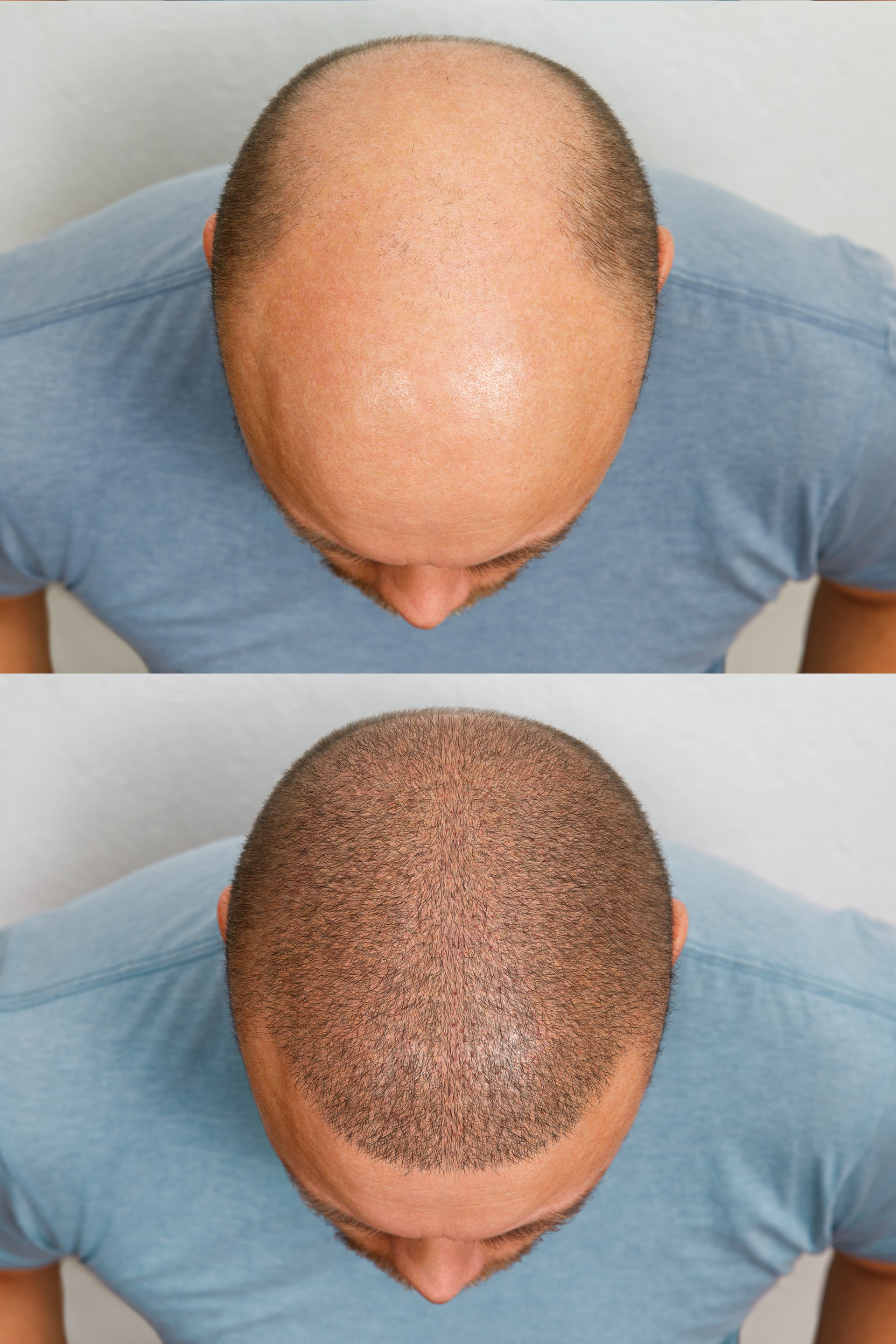 The head of a balding man before and after hair transplant surgery. A man losing his hair has become shaggy. An advertising poster for a hair transplant clinic. Treatment of baldness