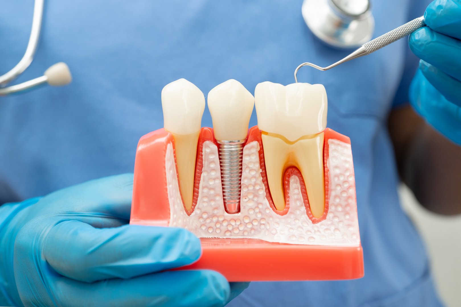 Dentist holding dental implant, artificial tooth roots into jaw, root canal of dental treatment, gum disease, teeth model for dentist.