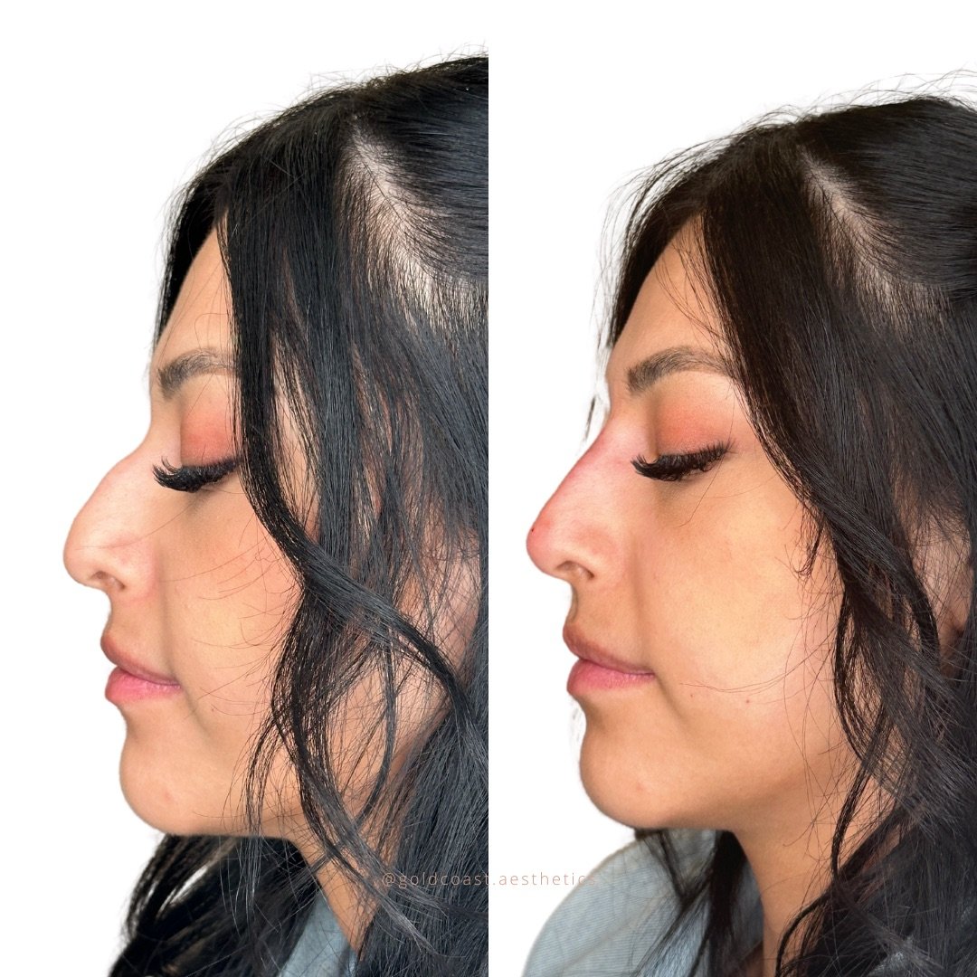 Non-surgical nose job transformation