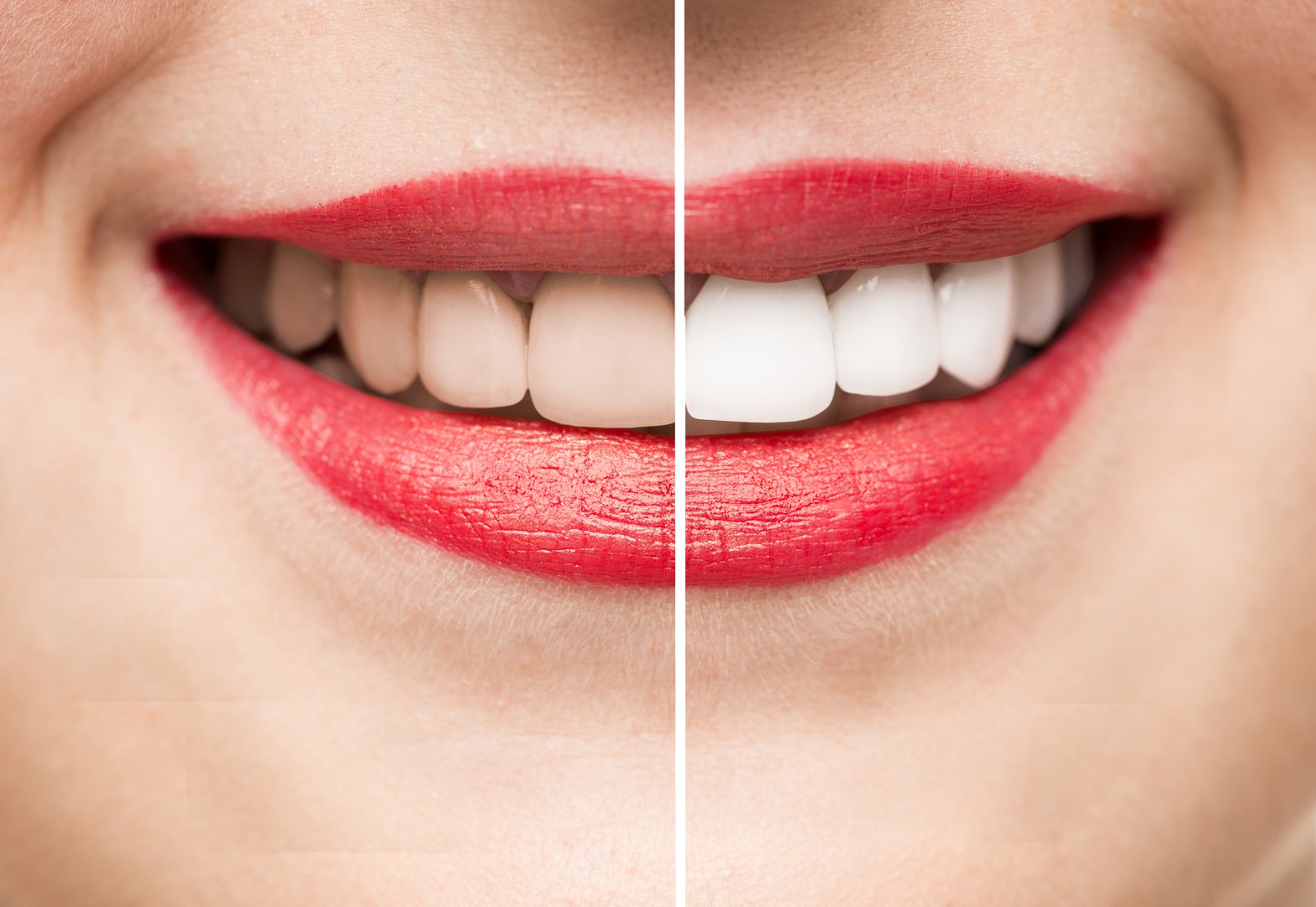 Teeth whitening before and after