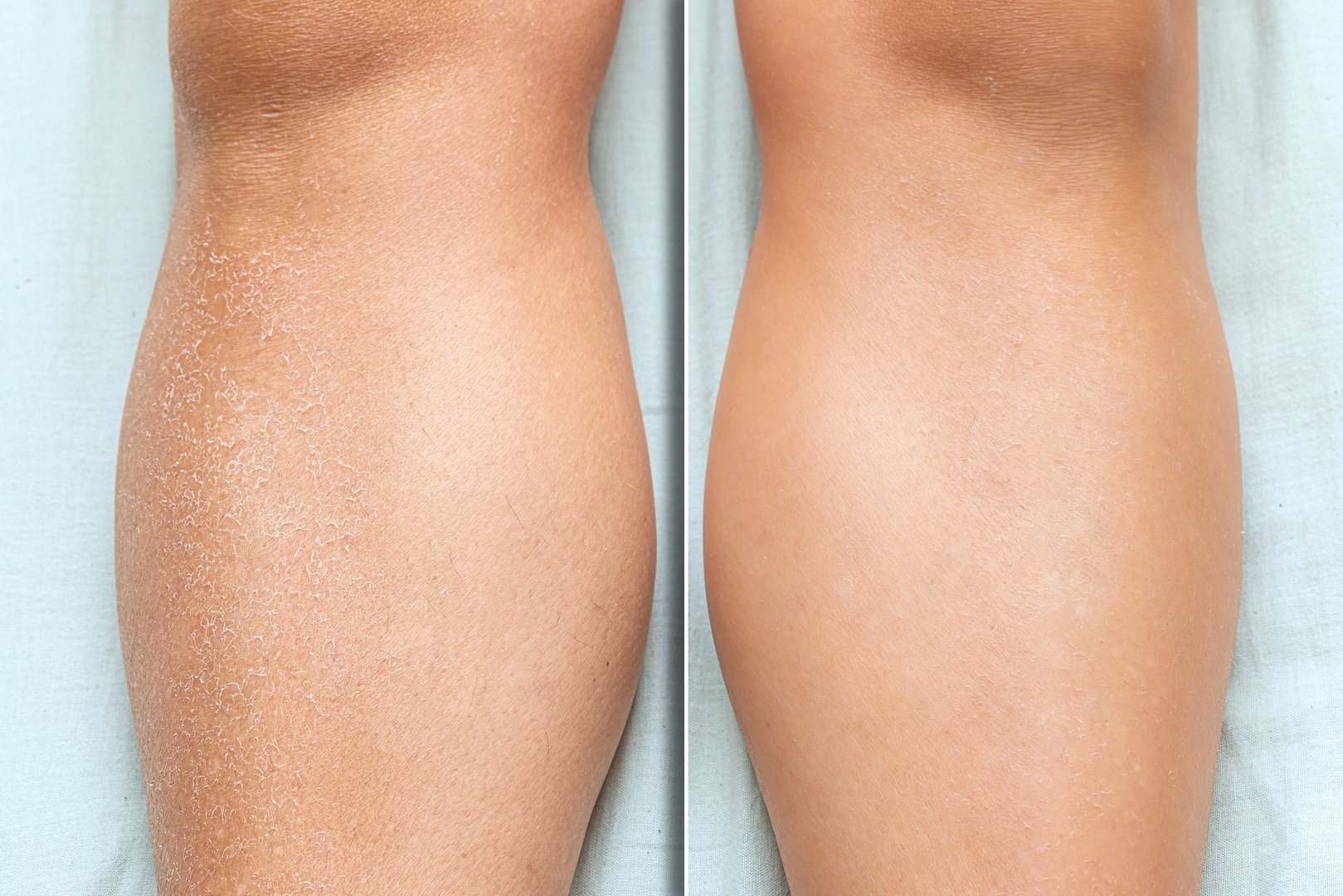 Before and after skin moisturization in detail, with dried and cracked skin against a flawless smooth complexion on woman legs.