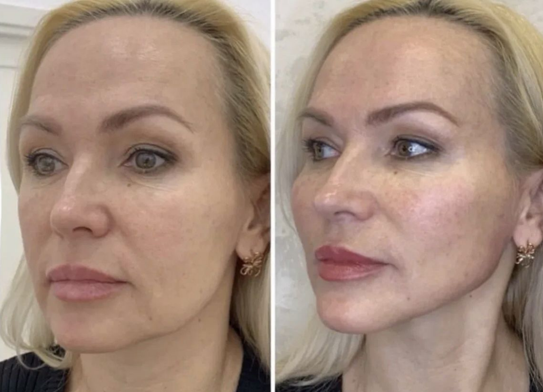 Rezultat przed i po zabiegu HIFU Face