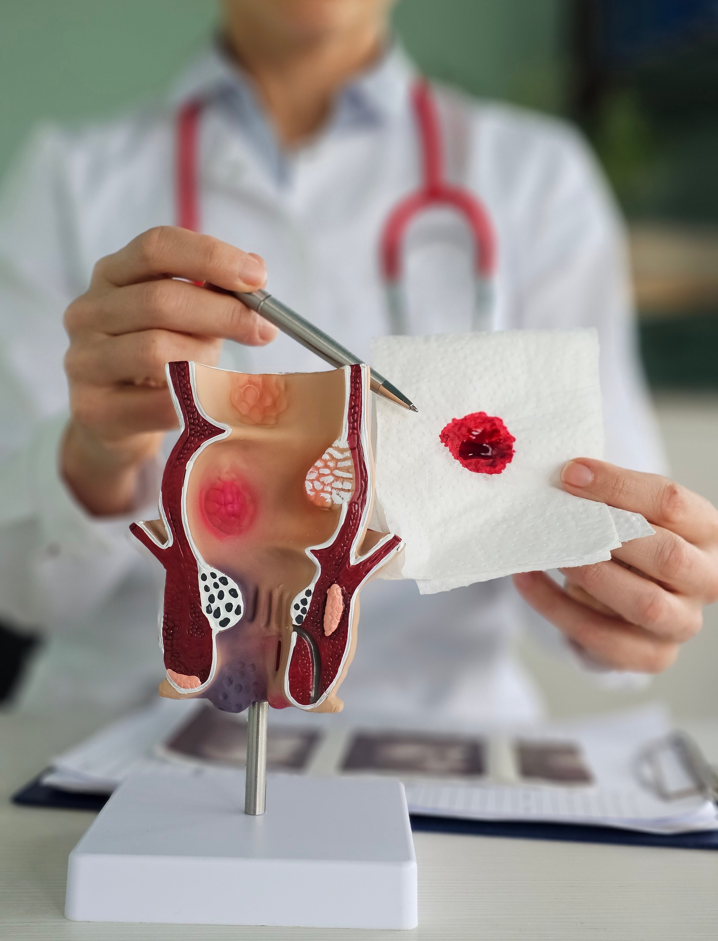 Proctologist and rectum and napkin with blood. Rectal bleeding Rectal bleeding causes, symptoms, diagnosis