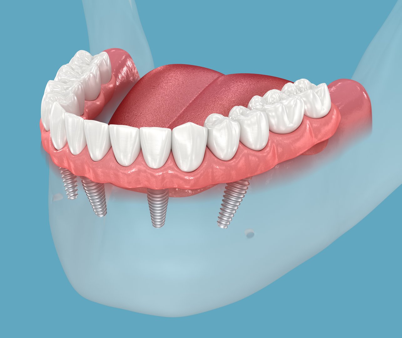Mandibular prosthesis console based on 4 implants.  Medically accurate 3D illustration of human teeth and dentures concept