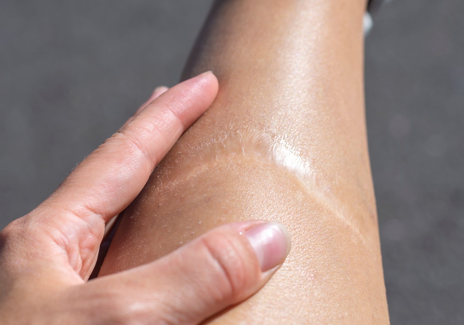 Close-up of a protracted scar on the leg. Postoperative scars