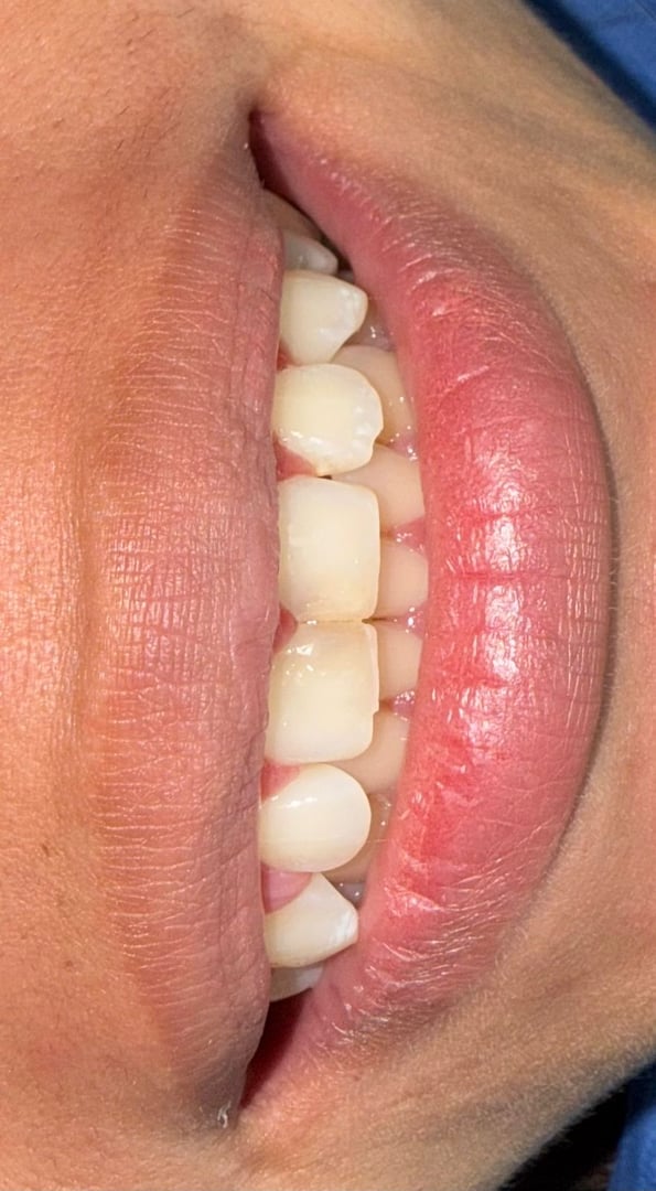 Antes del tratamiento - Carillas de resina