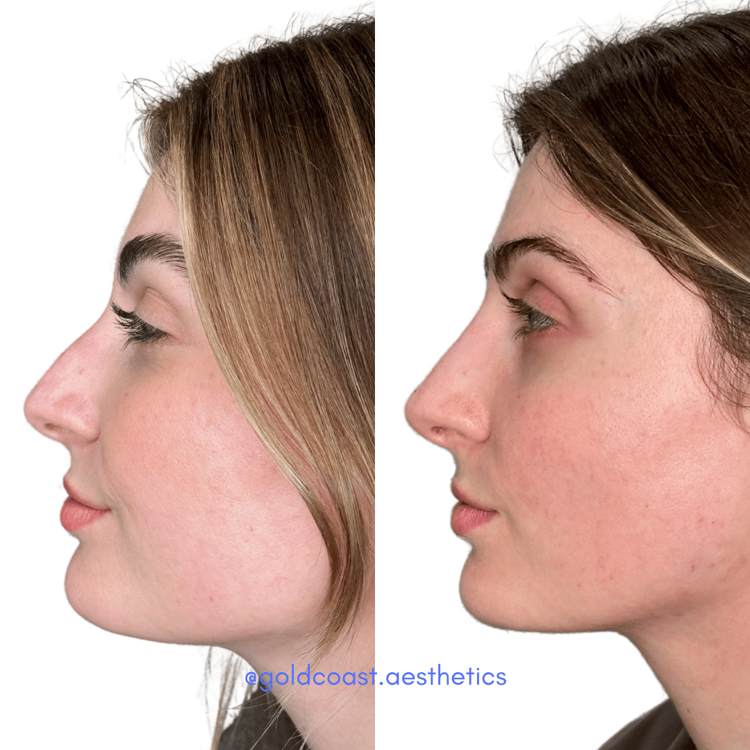 Non-surgical rhinoplasty before and after