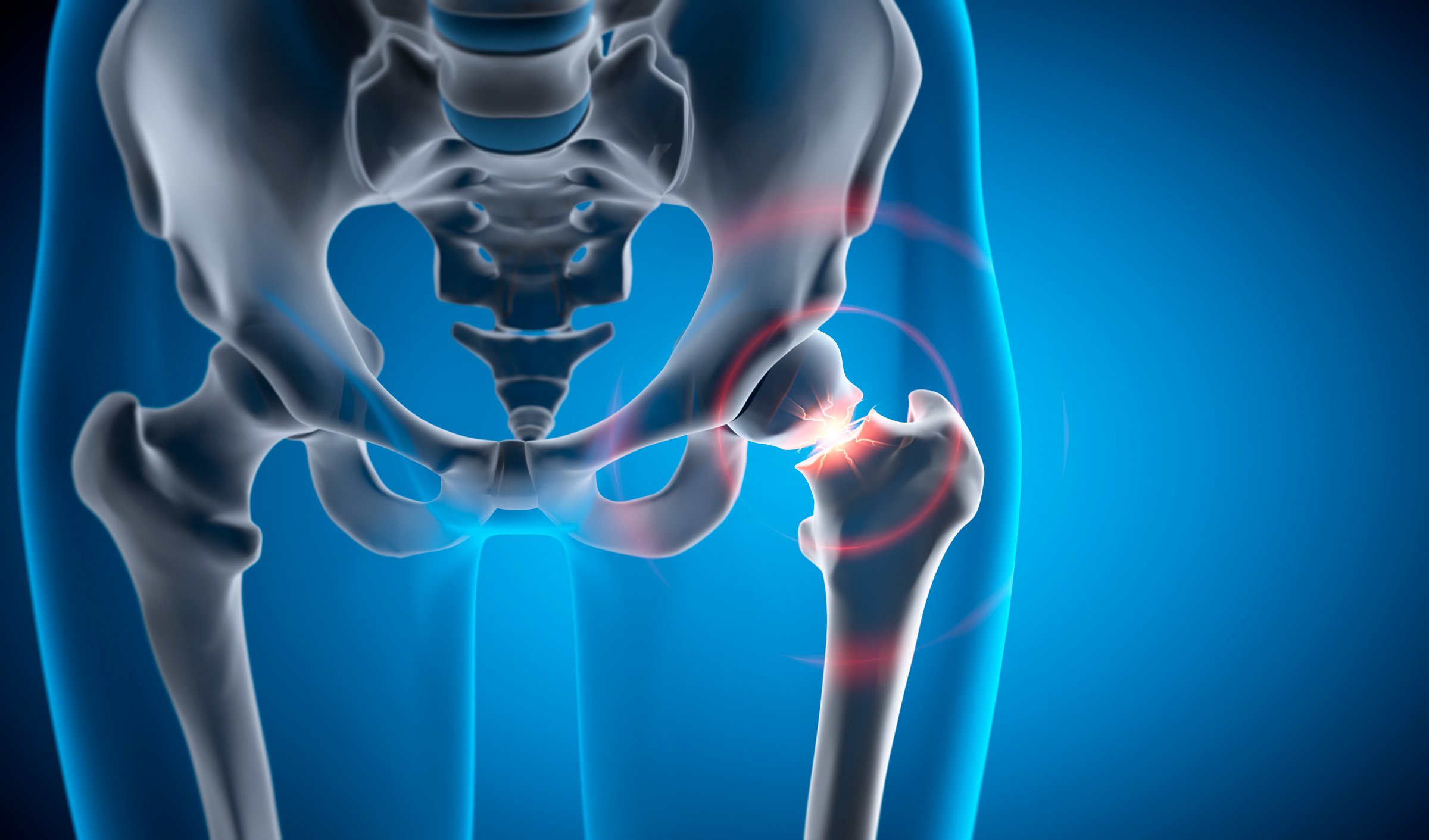 Hip joint with osteoarthritis showing joint degeneration