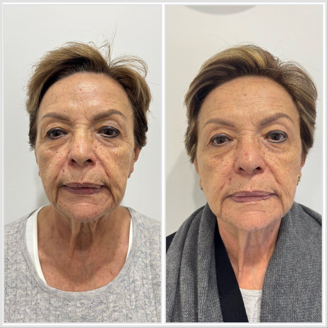 Antes y después de tratamiento con HIFU para lifting facial