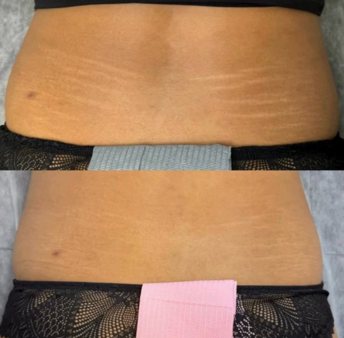Stretch marks before and after treatment
