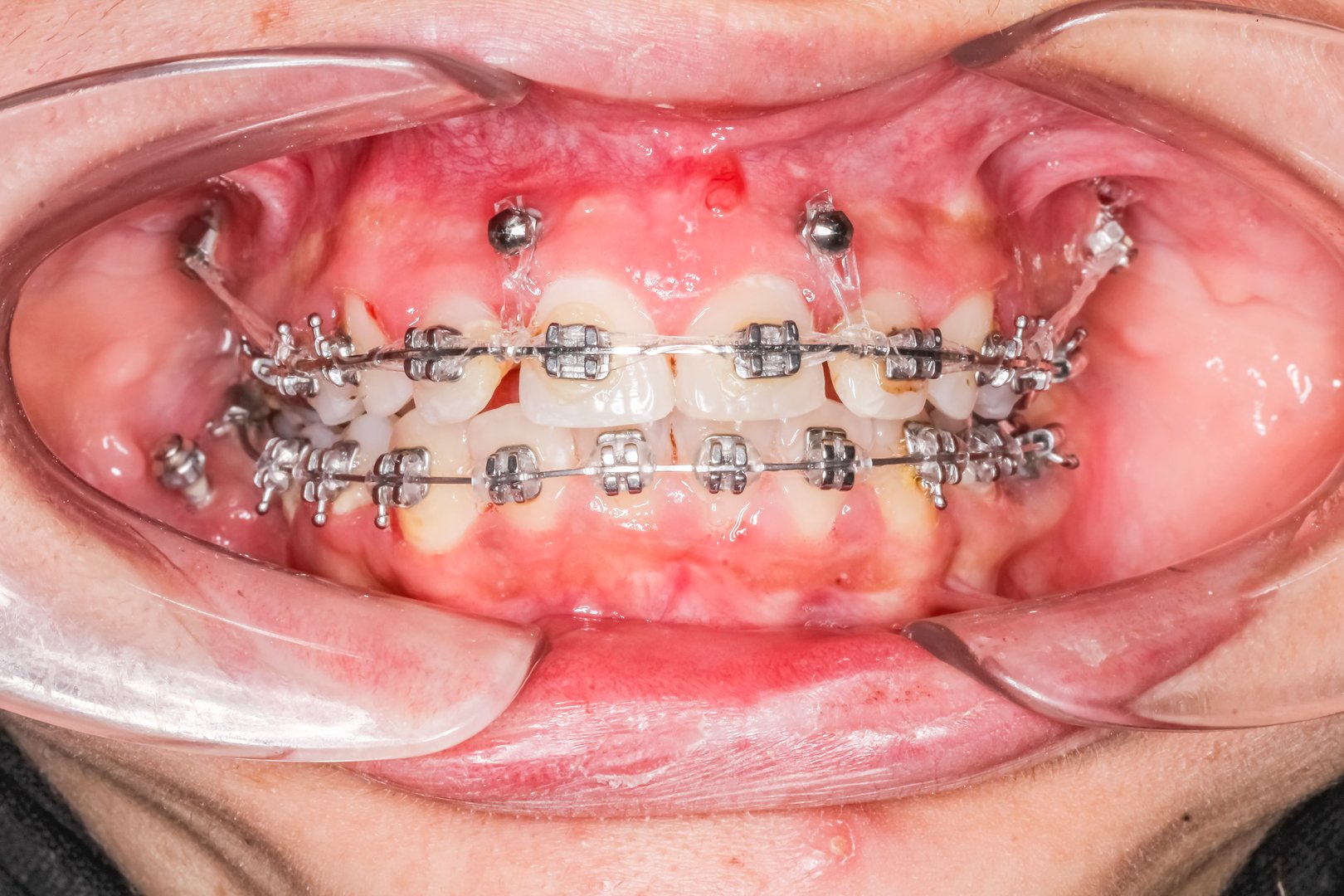 Frontal view of dental arches in biting teeth occlusion, orthodontic braces, elastic O-ring ligature, arch wire, cheeks and lips retracted with cheek retractor.