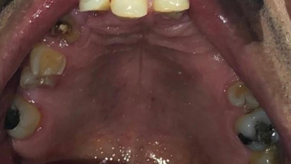 Fase 3: Diagnóstico inicial maxilar superior