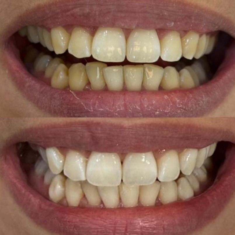 Clareamento Dental - Antes e Depois
