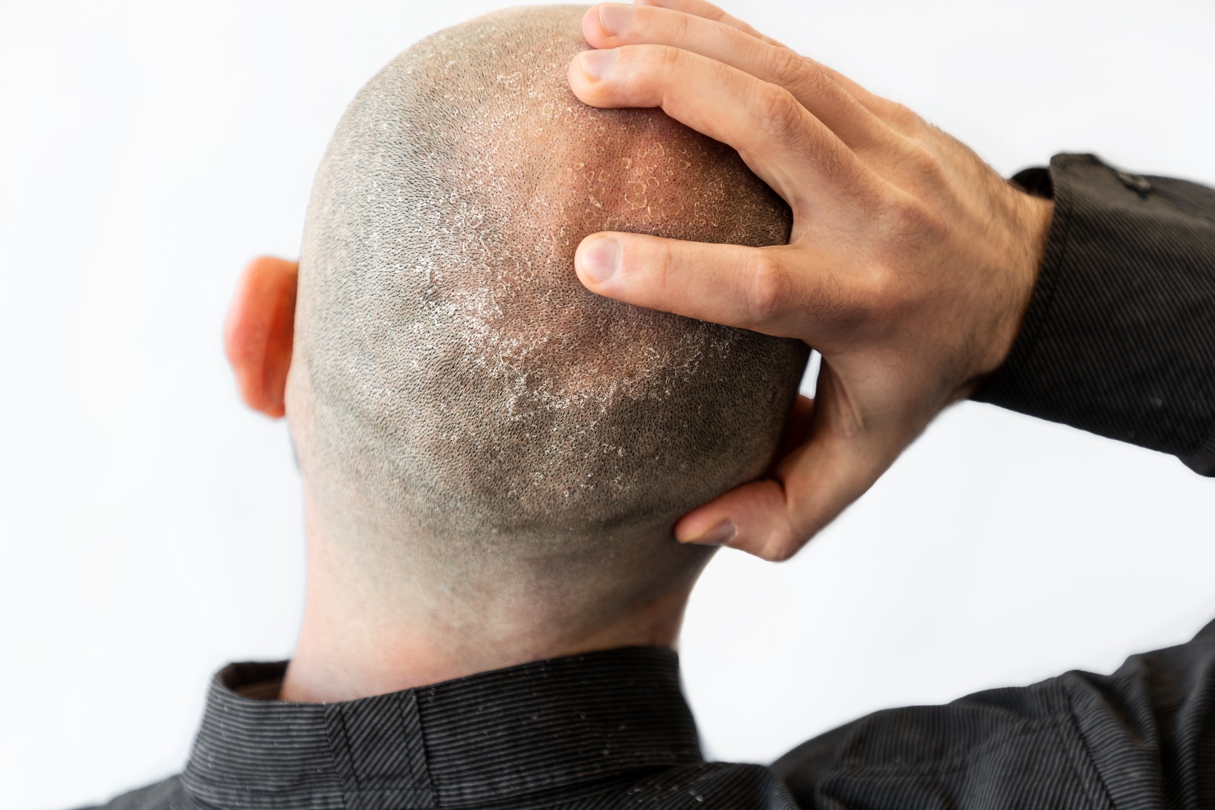 A man in a black shirt is holding his bald head covered with seborrheic dermatitis and dandruff. The concept of skin problems and alopecia.