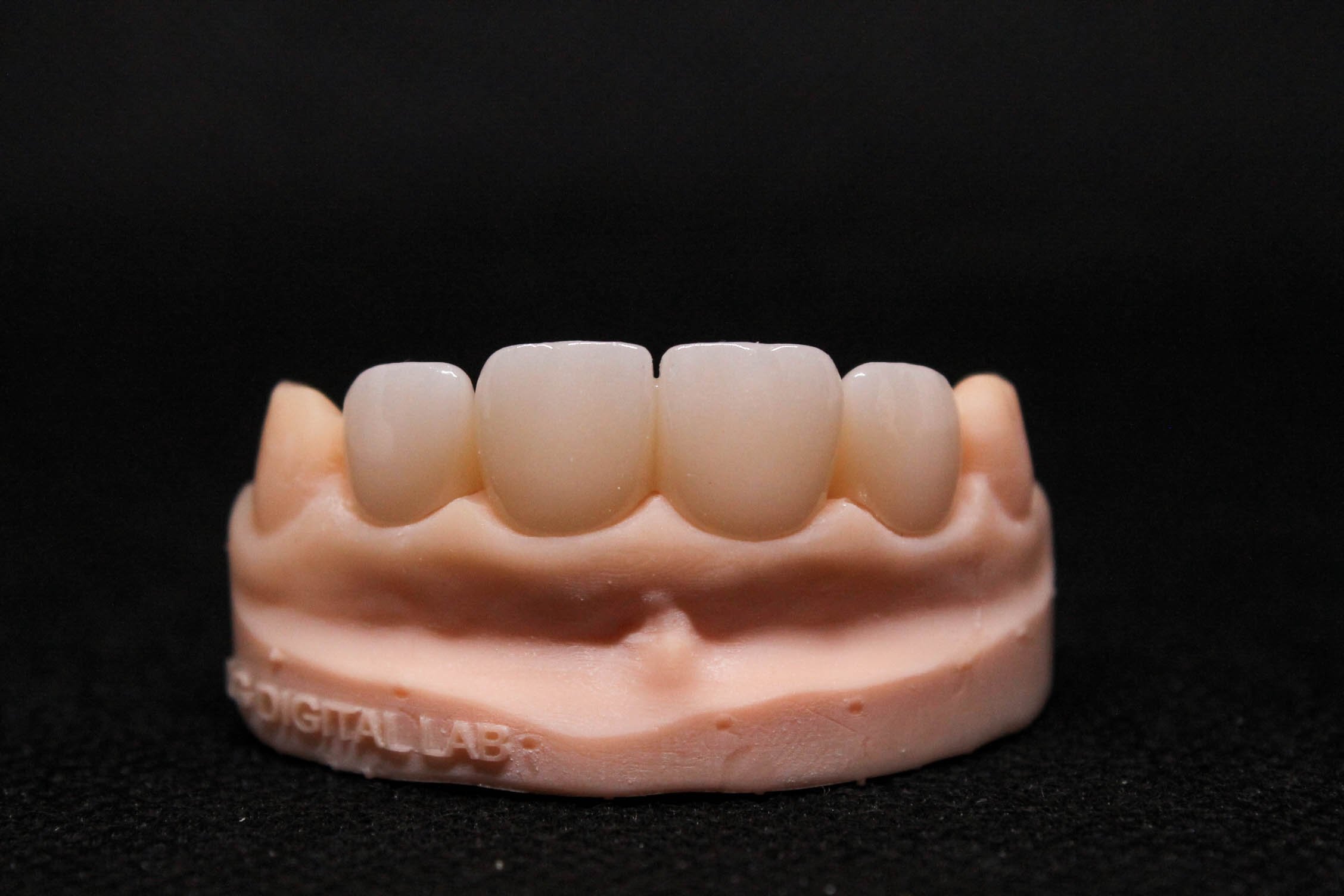 Puente dental de 4 unidades