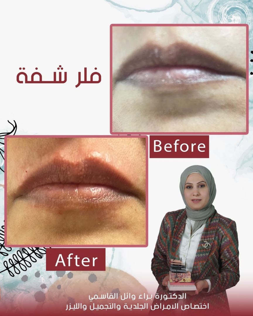 Before and after acne treatment results