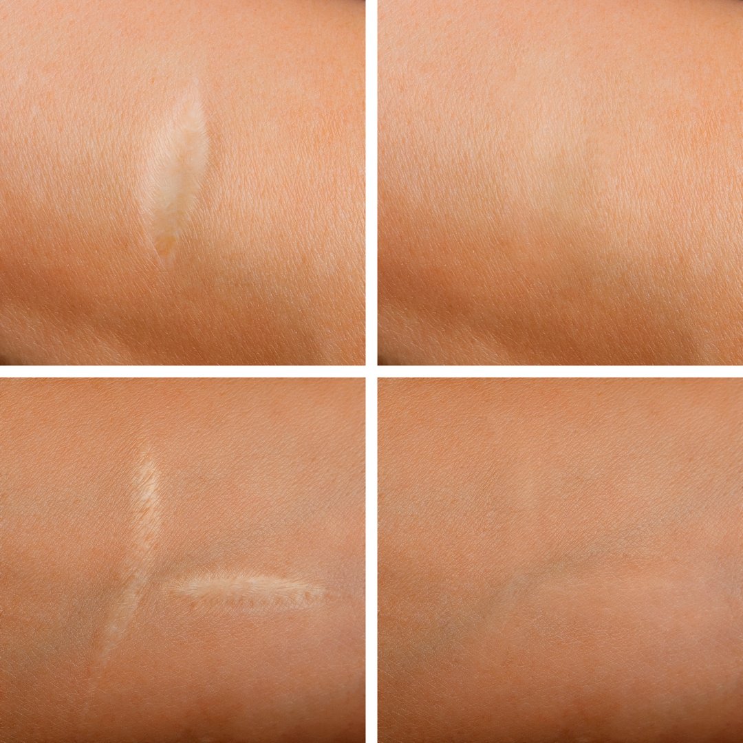 scar after surgery. Before and after removal.