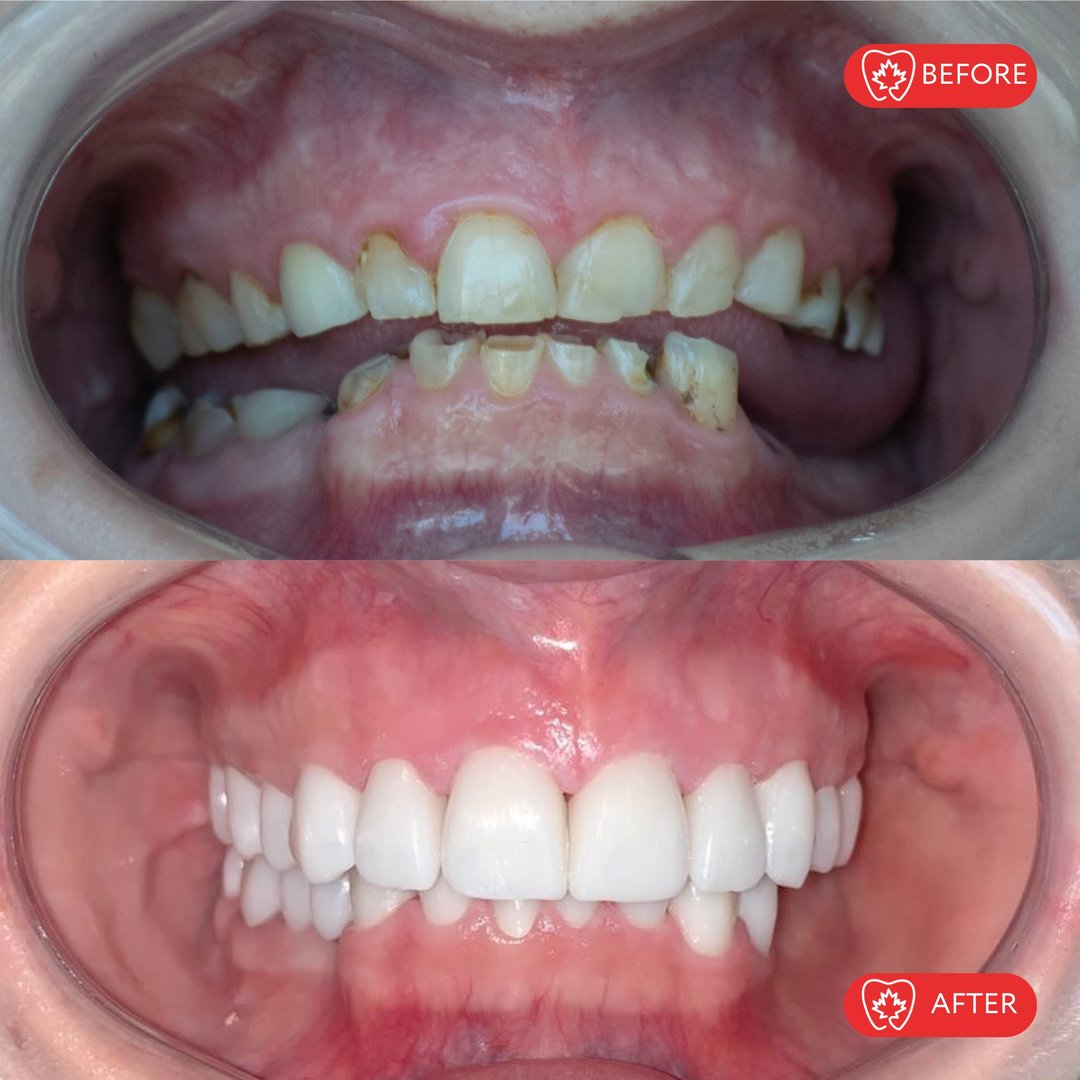 Antes del tratamiento