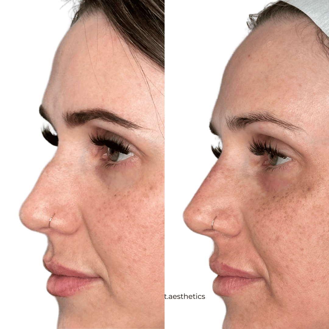 Non-surgical rhinoplasty results