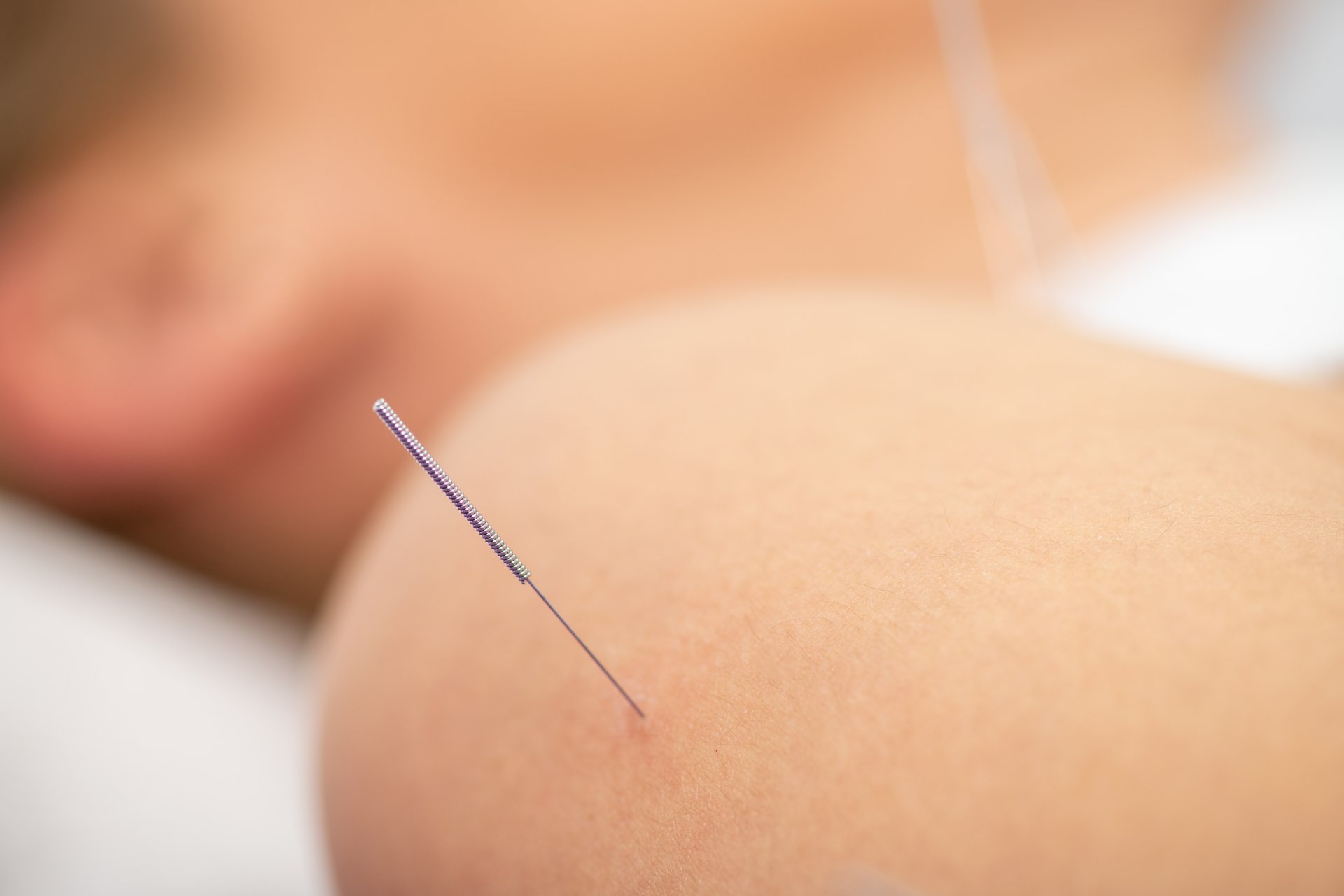 Woman receiving dry needling therapy on her shoulder during a physical therapy session. The treatment helps relieve muscle tension, reduce pain, and improve mobility for rehabilitation.