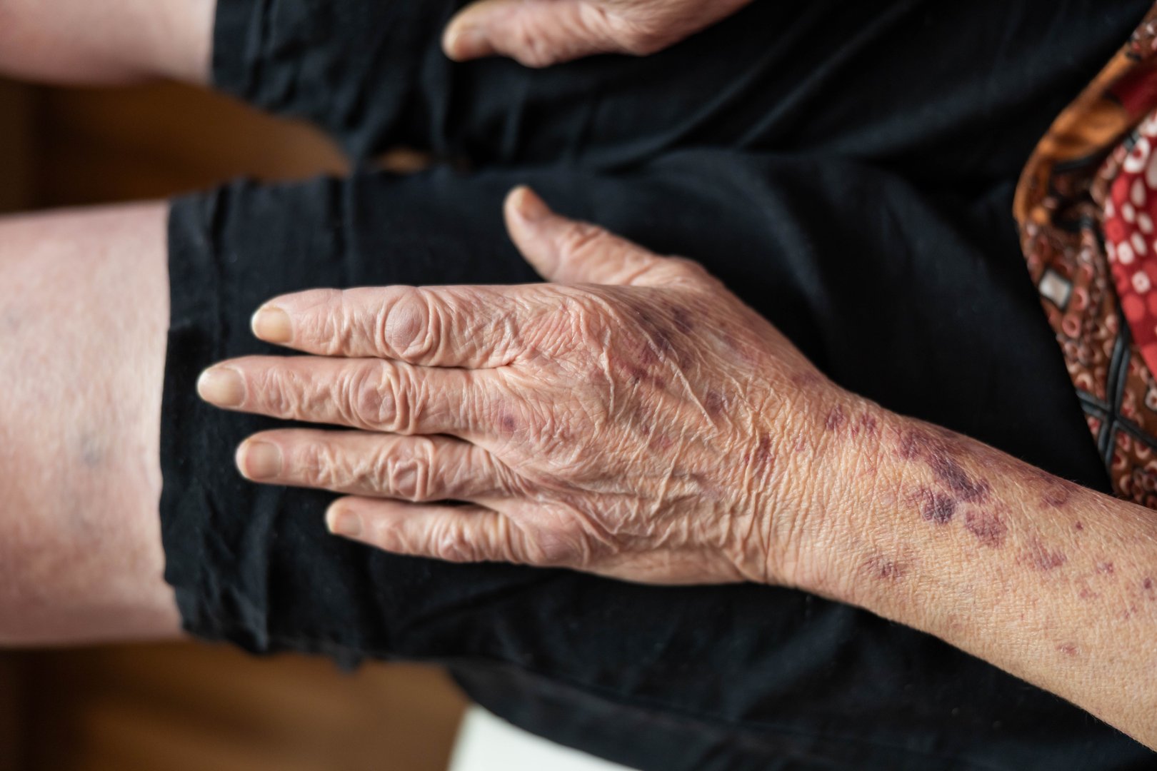 An elderly hand rests gently on a thigh, showcasing the natural beauty of aging skin, with visible wrinkles and spots that tell a rich story of a life well-lived and experienced.