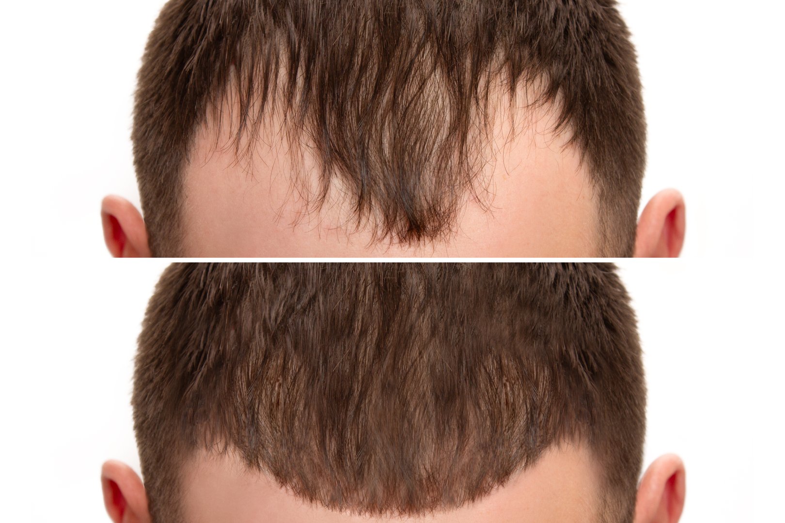 Cropped before and after head shot of a young male with bald patches on her forehead and temples. Baldness. Close-up, front view. Hair care and treatment concept. Hair loss, hair extensions, alopecia