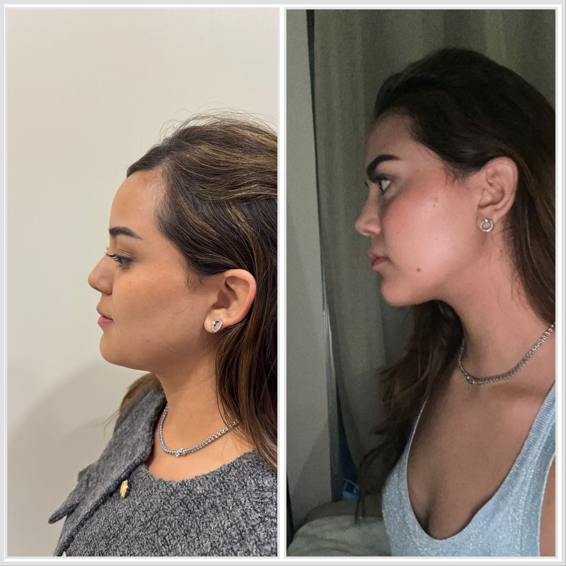 Antes y después - HIFU