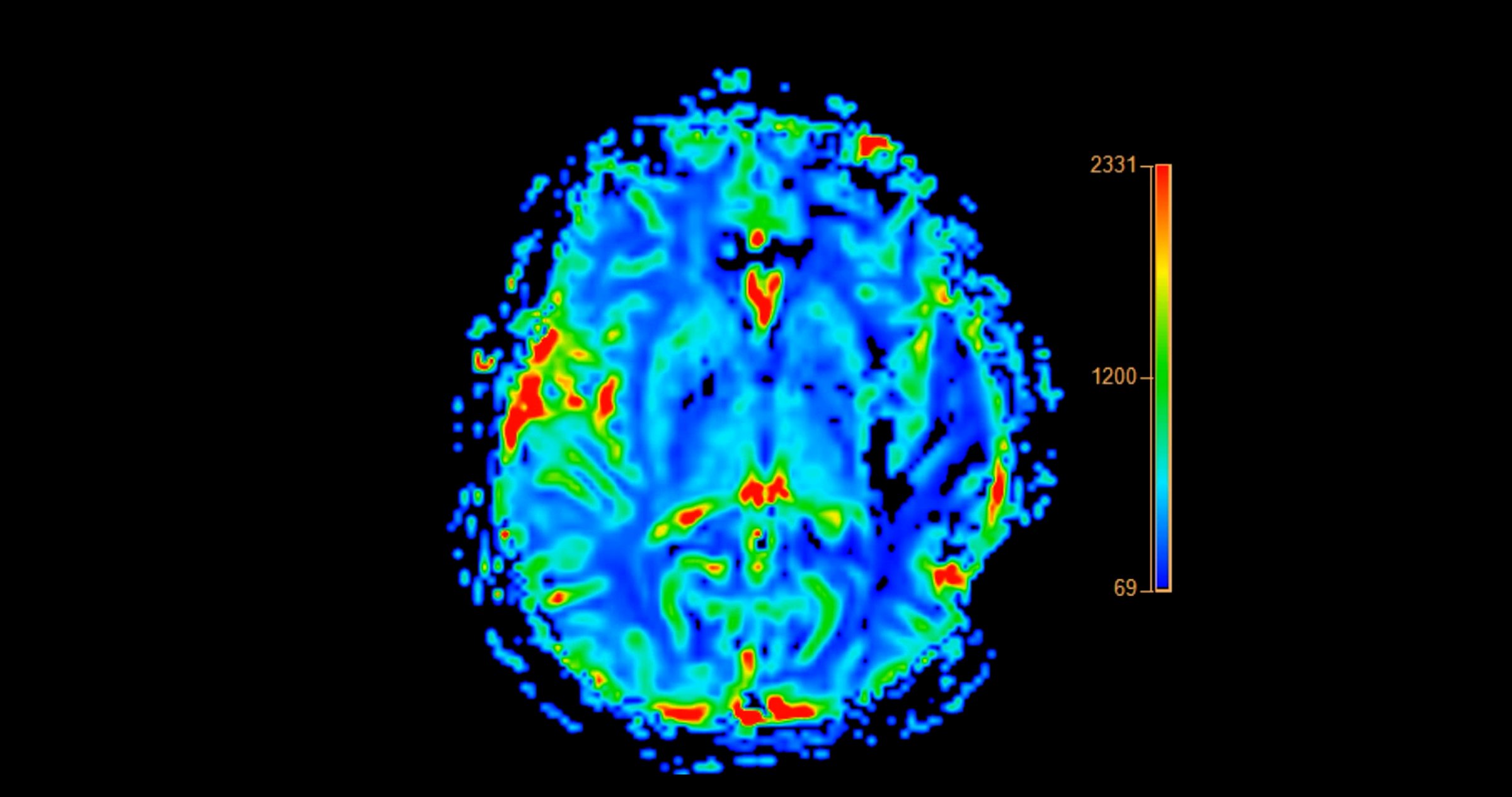 MRI brain perfusion imaging helps assess cerebral blood flow and tissue viability. It aids in diagnosing strokes, tumors, and other neurological conditions.