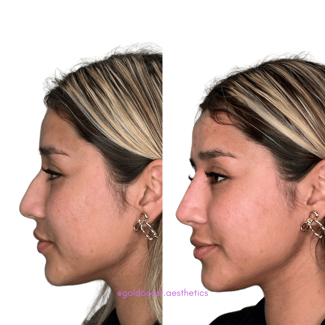 Nose reshaping before and after