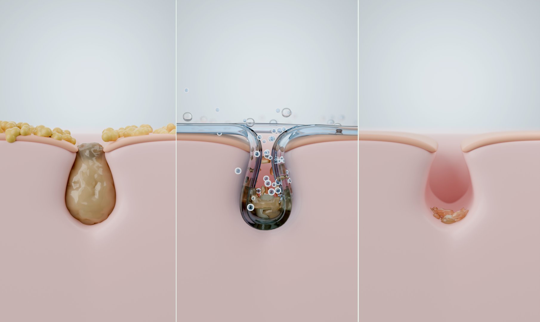 Deep pore cleansing process for oily skin and blackheads, 3 steps from clogged to clean with foam wash. conceptual 3d illustration, infographic.