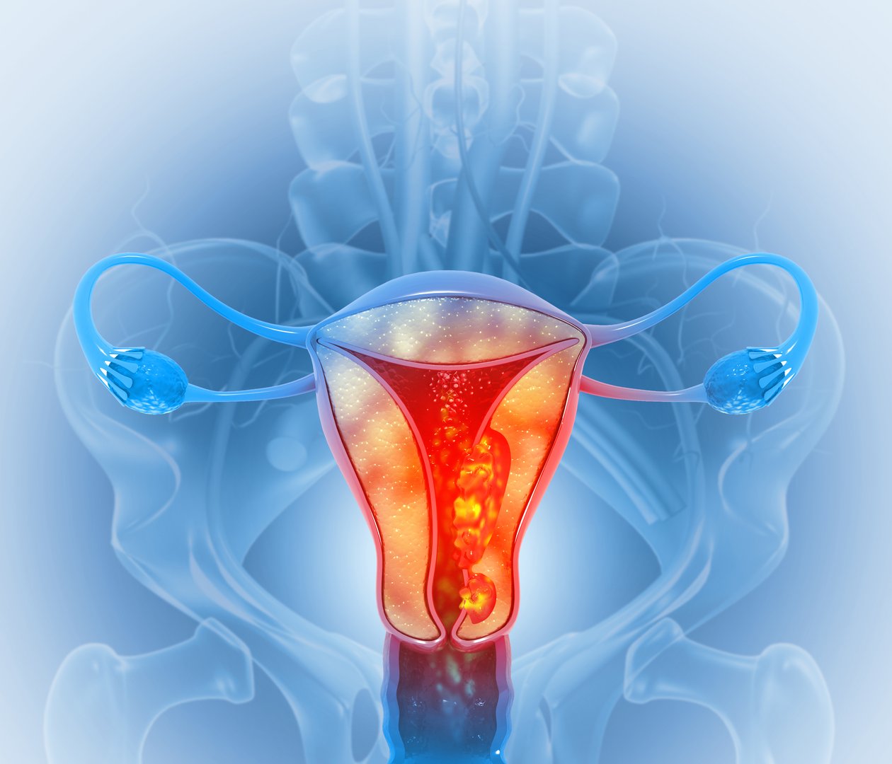 Uterus or uterine cancer. Medical concept as cancerous cells spreading in a female reproductive system. 3d illustration