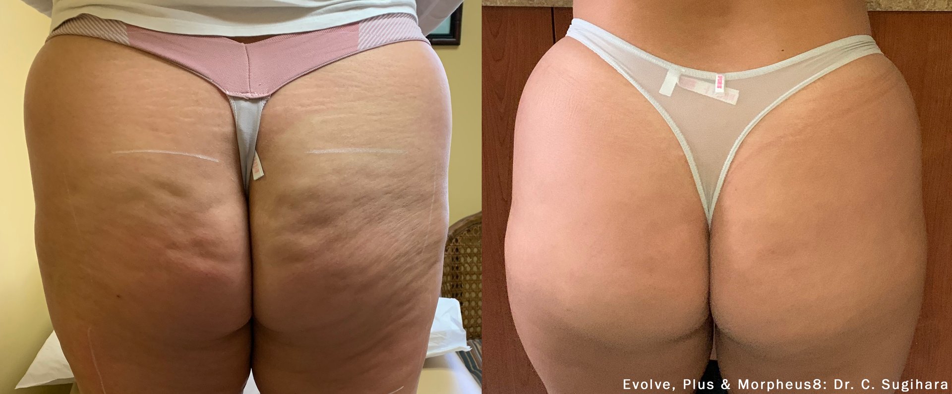 Evolve body sculpting before and after cellulite treatment results