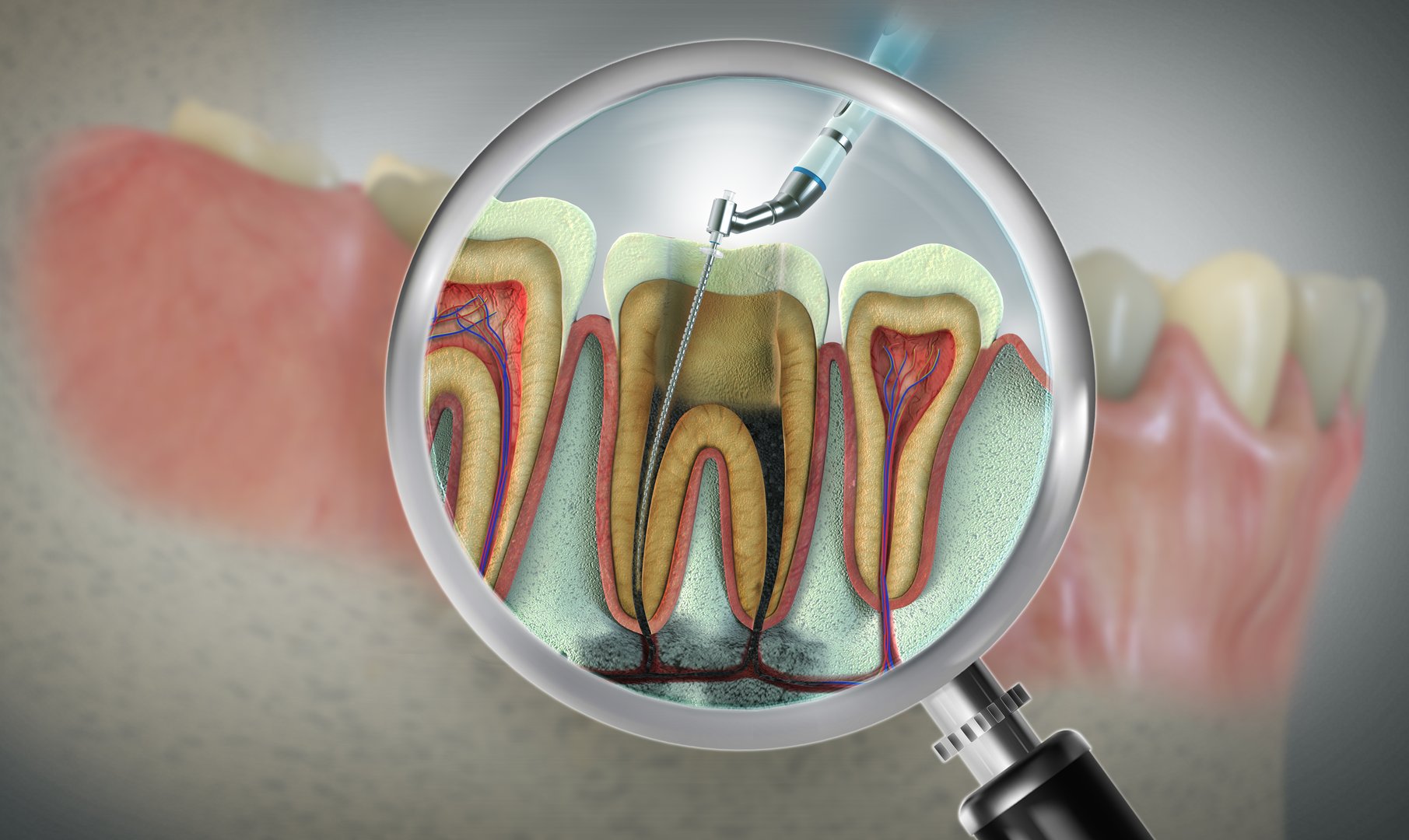 Advanced endodontic file in action...removing the infected enamel dentin and some parts of the pulp tissue.