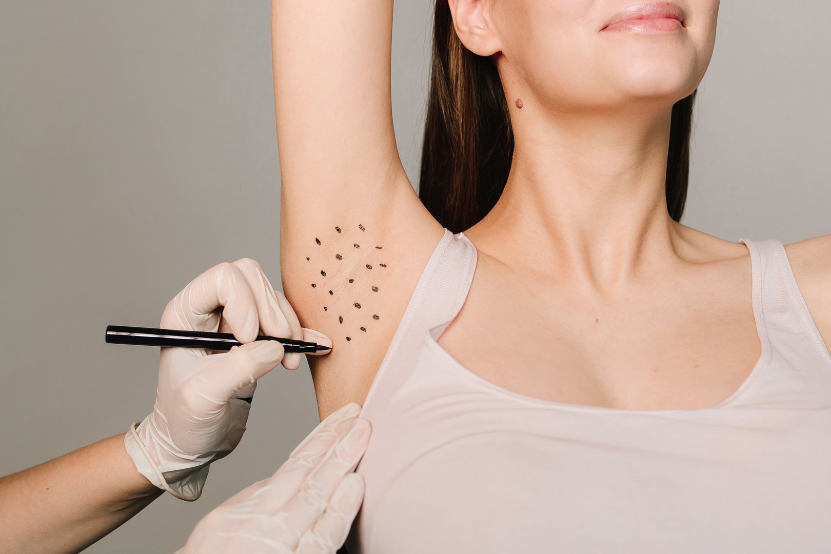 Cosmetologist is marking dotes before injecting woman's armpit, closeup. Treatment of hyperhidrosis. Markup skin for hyperhidrosis treatment in the clinic