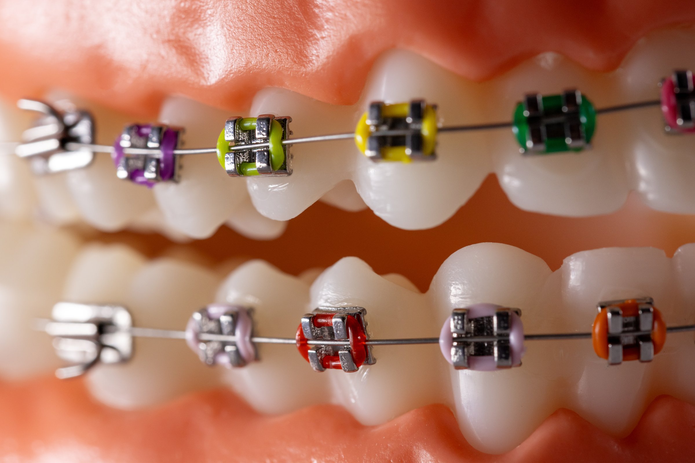 closeup of dental braces for teeth straightening