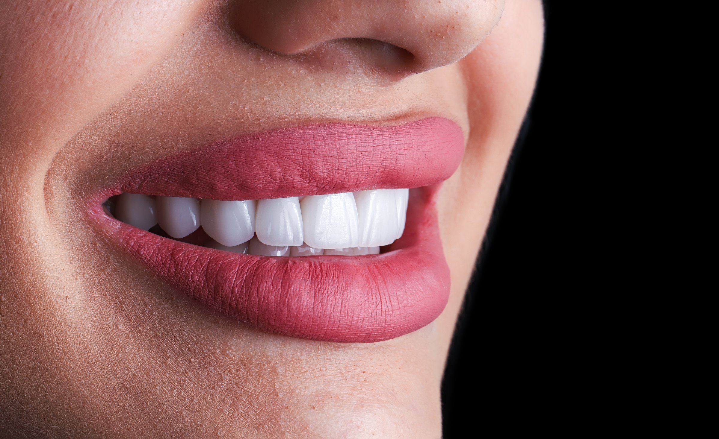 Beautiful woman with perfect smile showcasing white ceramic porcelain veneers results - cosmetic dentistry smile makeover transformation with natural-looking dental veneers at Murwillumbah Dental clinic