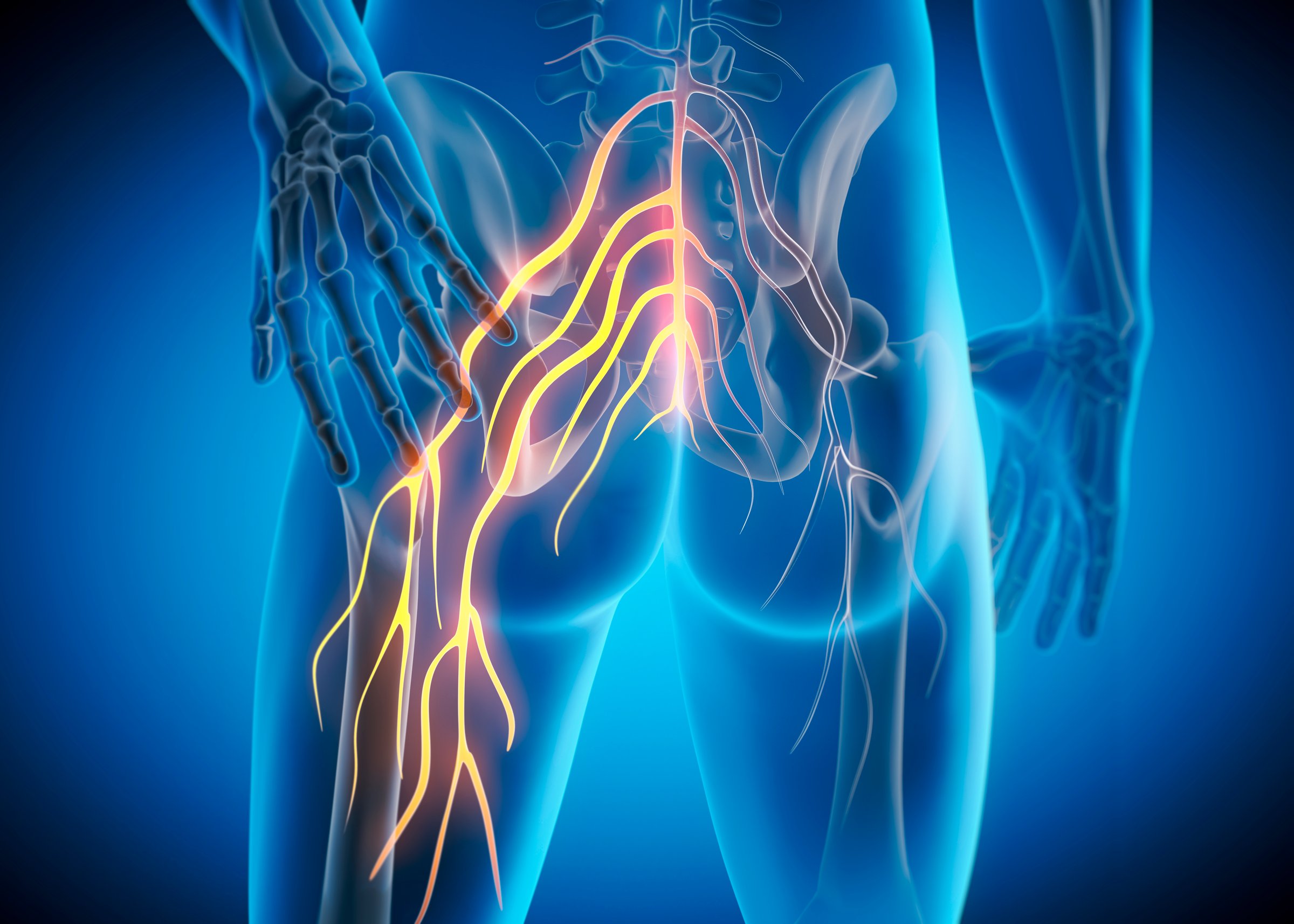Sciatica nerve pain illustration