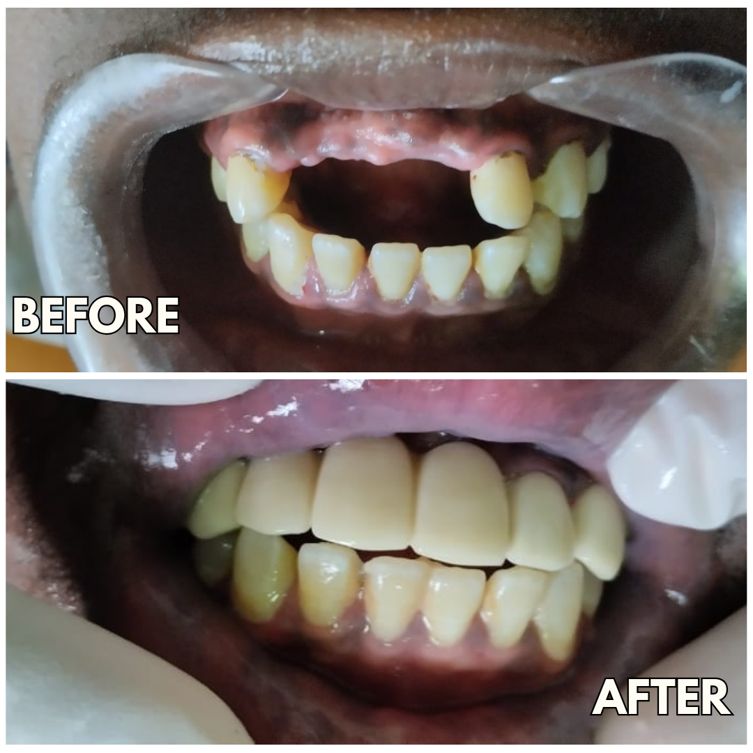 Dental bridge before and after treatment results