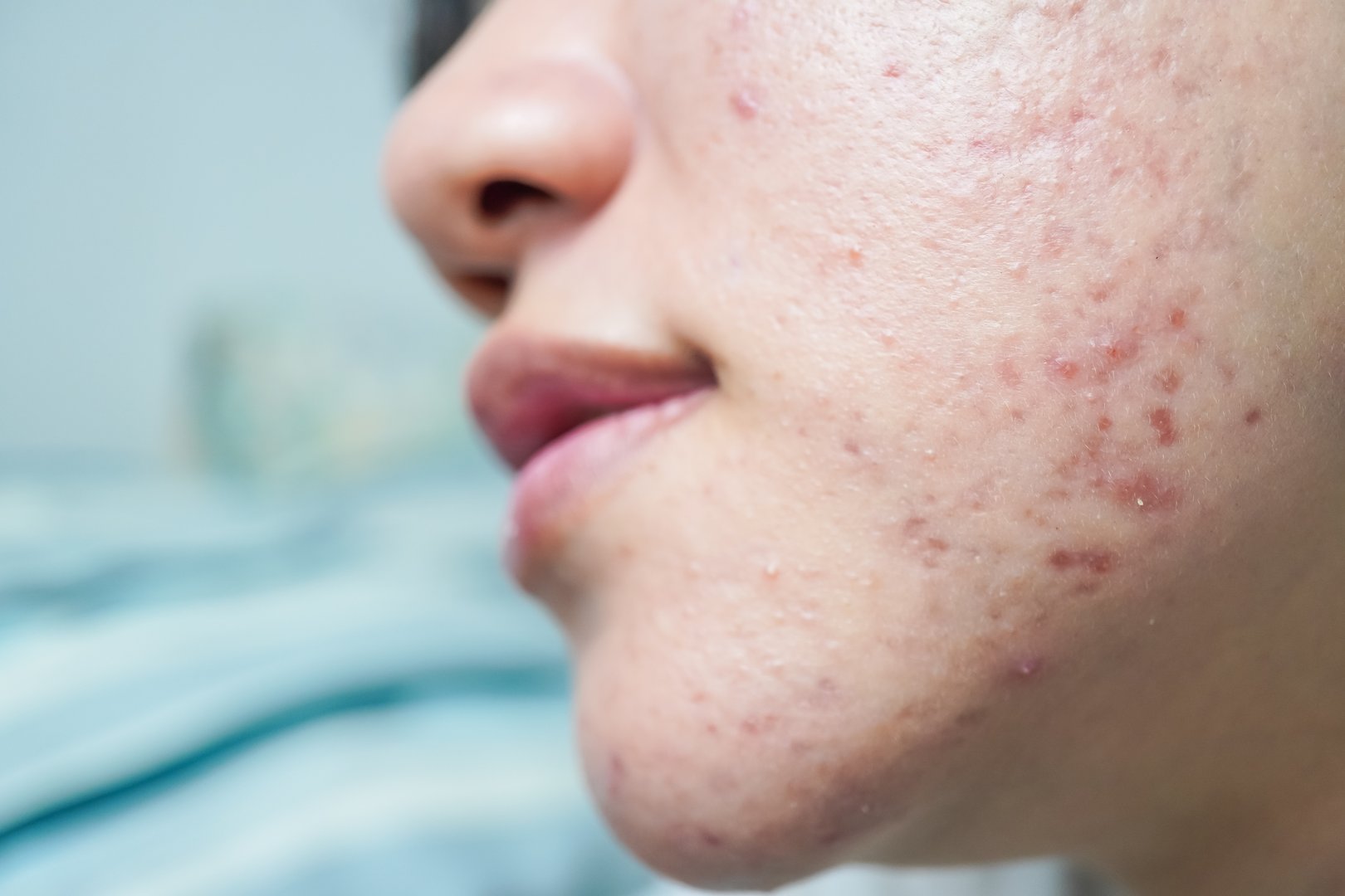Close up detail photo of The face of an Asian woman who has many pimples on her cheeks. Hormonal acne, puberty and before menstruation.