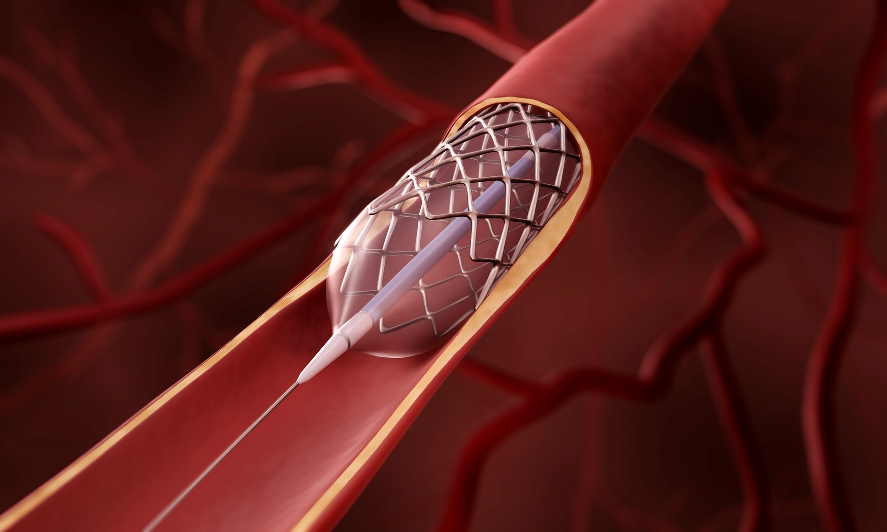 Balloon angioplasty, Stent insertion 3d illustration