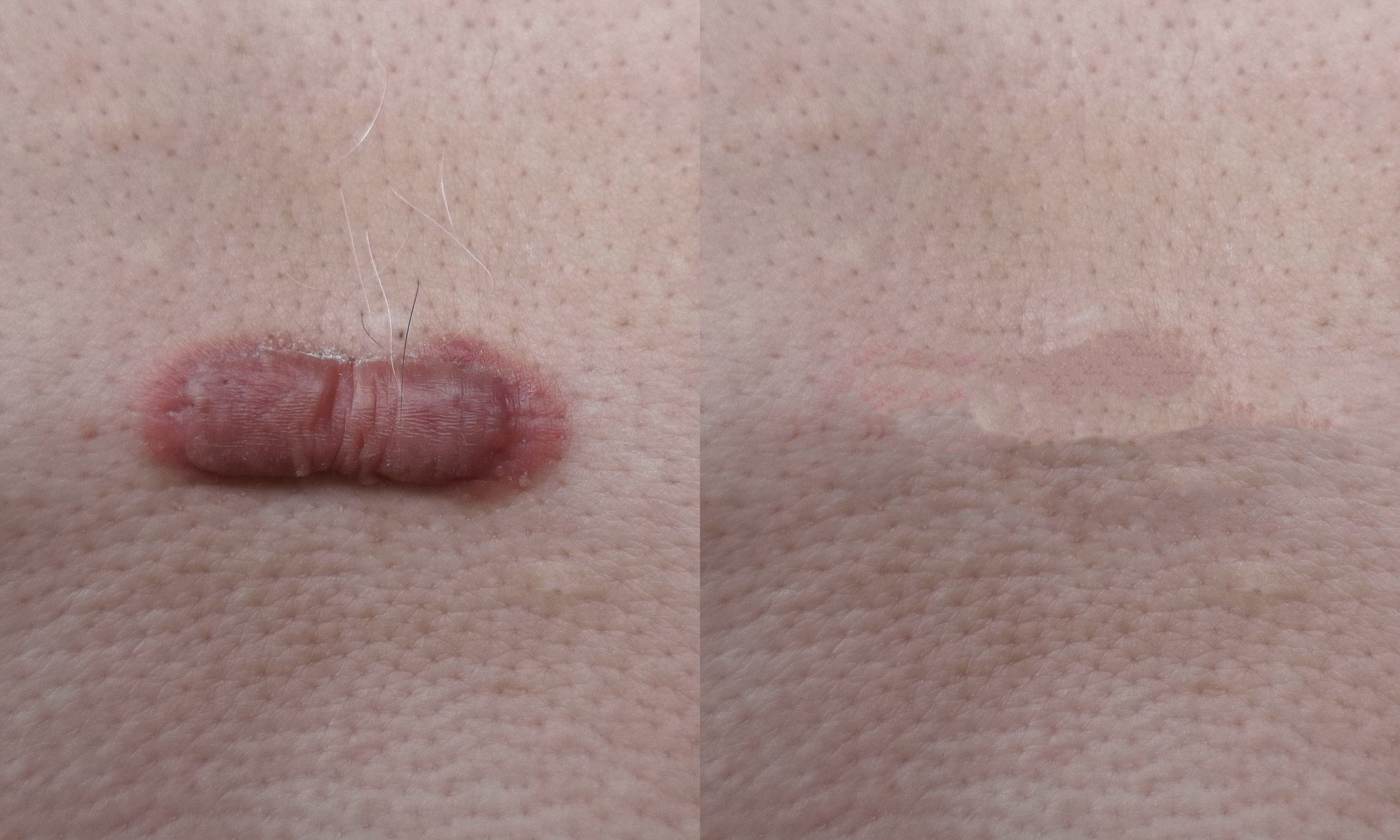Keloid scars before and after treatment.