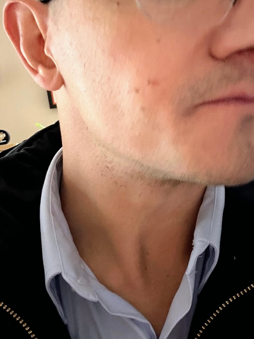 Scar revision after treatment