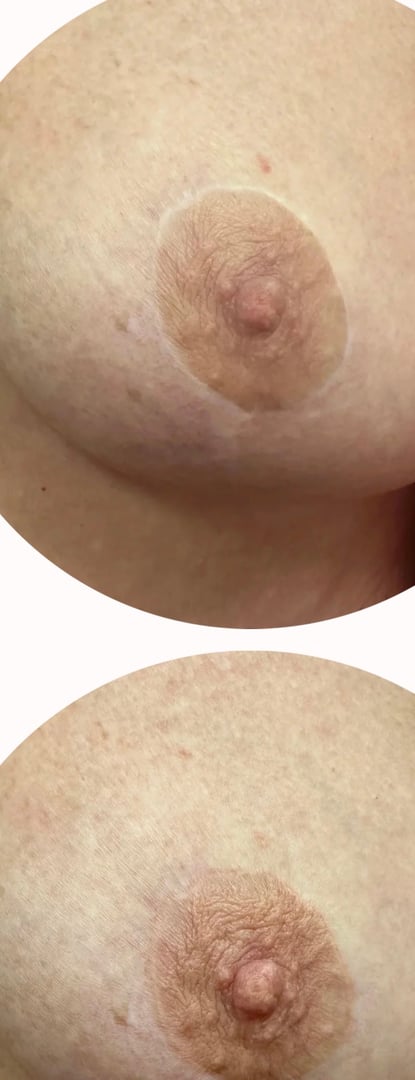 Before and after breast restoration scar camouflage result